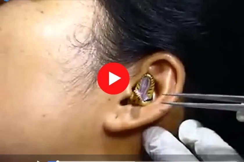 Saanp Ka Video: बिल समझकर लड़की के कान में घुस गया सांप, डॉक्‍टर को निकालने के लिए करनी पड़ी मशक्‍कत